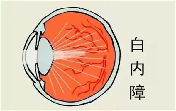 上海醫(yī)大眼科白內(nèi)障手術(shù)8千-3萬起，不同品牌晶體價(jià)格有些許差異