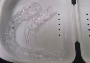 隱形牙齒矯正牙套
