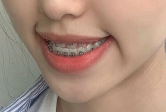 廣州美萊口腔整牙