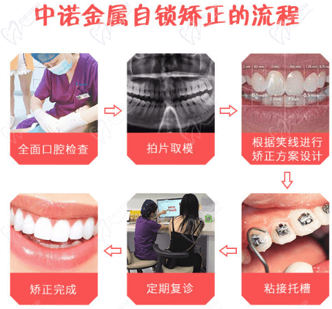 中諾口腔矯正流程
