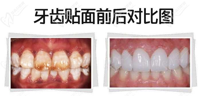 我做牙齒貼面5年后感受，看瓷貼面效果圖