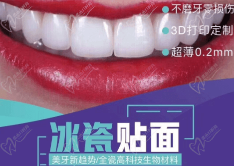 什么是冰瓷貼面？