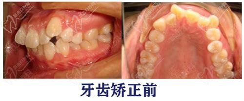 北京斯邁爾口腔牙齒矯正前