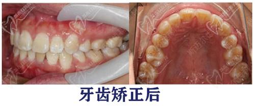 北京斯邁爾口腔牙齒矯正后