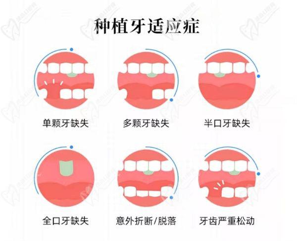 種植牙適用人群