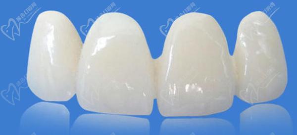 冰瓷牙和全瓷牙哪一個(gè)更好？看完冰瓷牙和全瓷牙的區(qū)別就明了