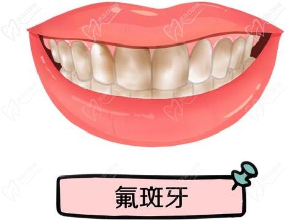 氟斑牙是什么原因造成的？