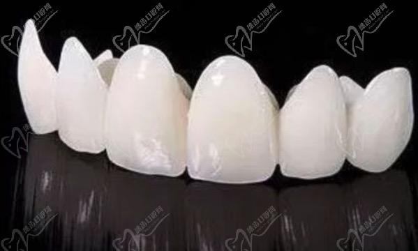 請(qǐng)問(wèn)牙齒貼面跟全瓷冠的區(qū)別有哪些？