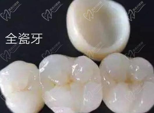 請(qǐng)問(wèn)牙齒貼面跟全瓷冠的區(qū)別有哪些？