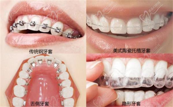 寧波陌客爾口腔牙齒矯正怎么樣價格貴嗎？