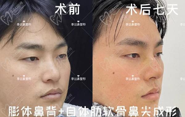 重慶李喆做鼻子怎么樣？口碑評(píng)價(jià)