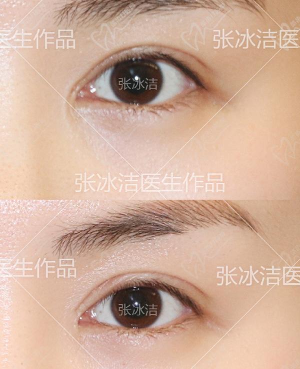 張冰潔修復內(nèi)眼角范例圖片參考
