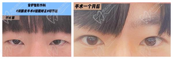 韓國愛護整形醫(yī)院眼修復
