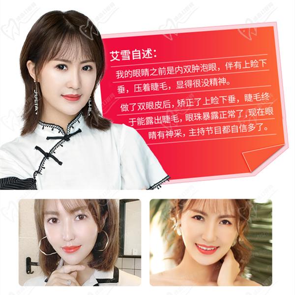 張姣姣真人雙眼皮手術(shù)圖