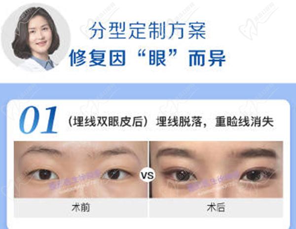 徐曉斐雙眼皮修復案 例