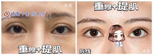 徐曉斐雙眼皮修復案 例
