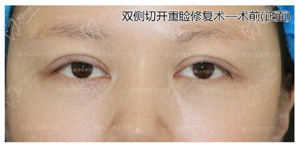 張冰潔雙眼皮修復(fù)案 例圖：肉條腫過寬過深、睜眼費(fèi)力眼睛無神