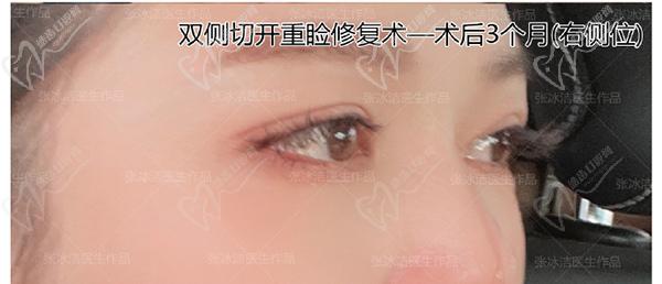 張冰潔雙眼皮修復(fù)案 例圖：肉條腫過寬過深、睜眼費(fèi)力眼睛無神