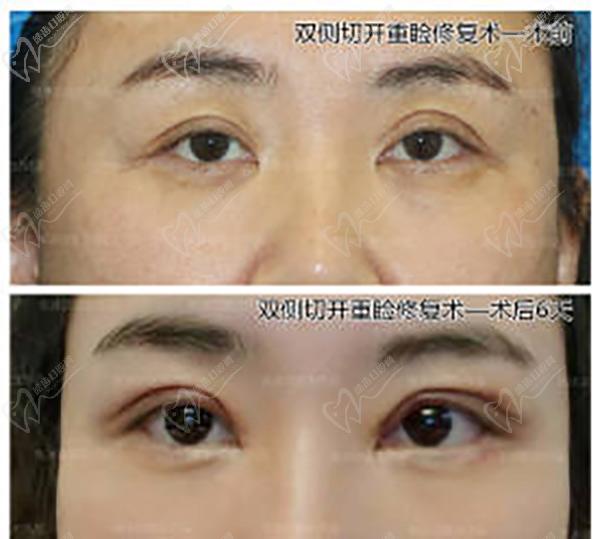 張冰潔雙眼皮修復(fù)案 例圖：不對(duì)稱、三角眼