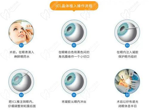 王曉瑛醫(yī)生做ICL晶體植入手術技術高超