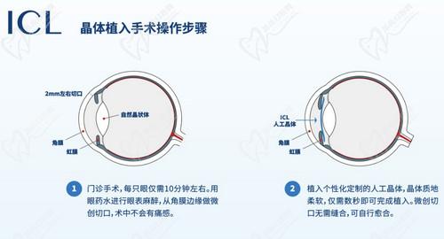 王曉瑛醫(yī)生做ICL晶體植入手術很出色