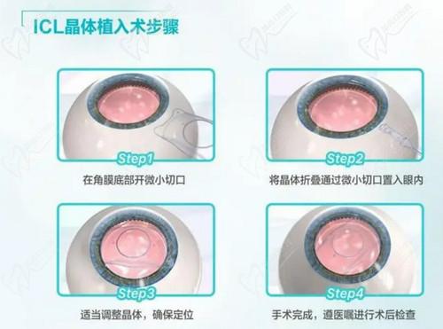 王曉瑛醫(yī)生做ICL晶體植入手術備受青睞