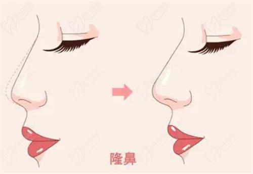 毛運(yùn)春醫(yī)生做鼻子怎么樣？