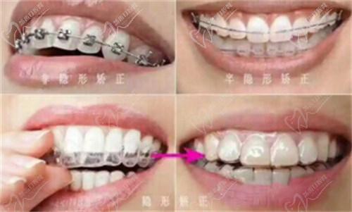 南寧柏樂(lè)口腔正畸醫(yī)生周奉城口碑好