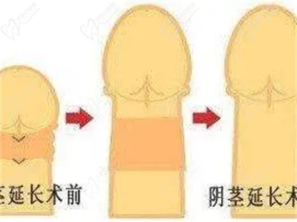 國內(nèi)玻尿酸增粗多少錢