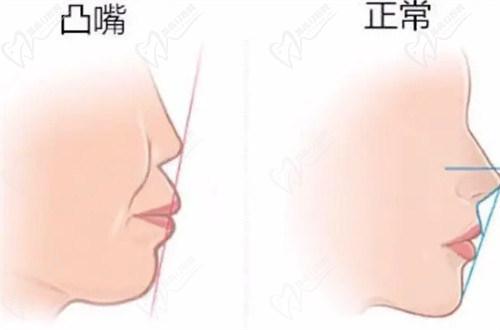 南寧柏樂口腔醫(yī)院牙齒矯正多少錢？