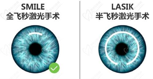 昆明近視手術哪家醫(yī)院好？