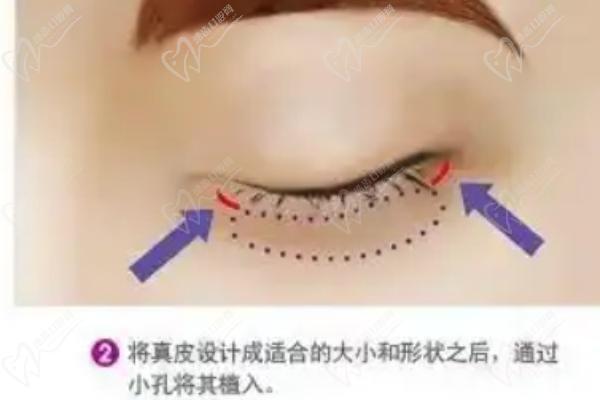 外眥修復(fù)、提升、成形術(shù)的區(qū)別與選擇