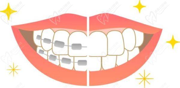 廈門登特口腔醫(yī)院正雅隱形矯正怎么樣