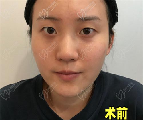 為什么選擇杜園園醫(yī)生做雙眼皮手術(shù)？