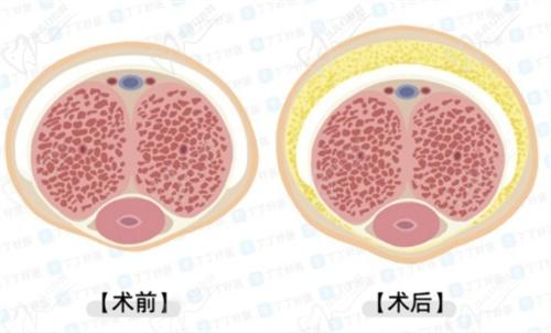 李世榮醫(yī)生做一次延長手術(shù)多少錢