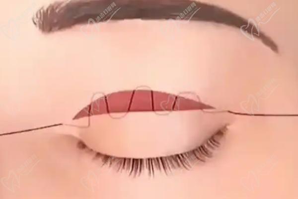 王衡健雙眼皮修復(fù)實(shí)例實(shí)證