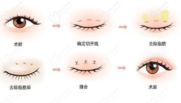 王衡健雙眼皮修復(fù)