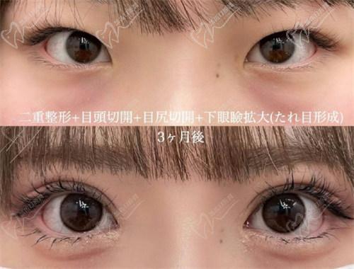 北京豐聯麗格醫(yī)療美容師麗麗修復雙眼皮怎么樣？