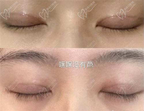 北京豐聯麗格醫(yī)療美容師麗麗修復雙眼皮怎么樣？