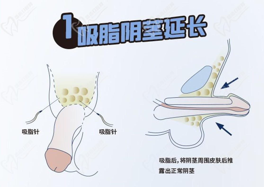 李世榮延長(zhǎng)手術(shù)為什么那么貴