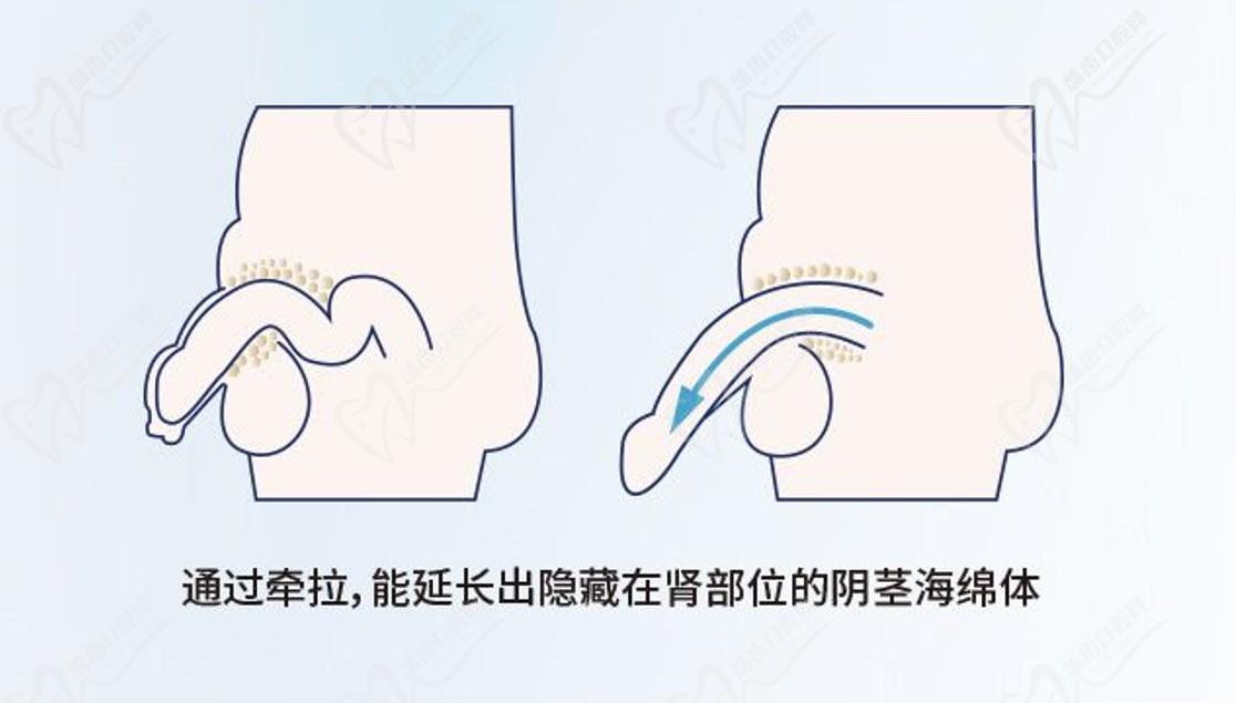 李世榮延長(zhǎng)手術(shù)之所以厲 害