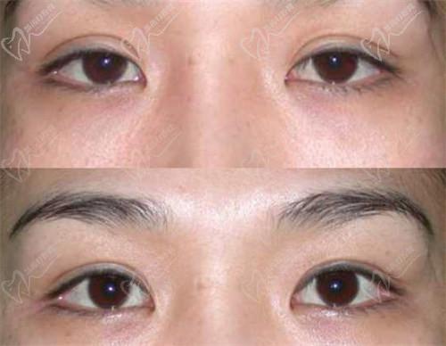 三、北京師麗麗雙眼皮修復(fù)與內(nèi)眼角修復(fù)的成功實例：
