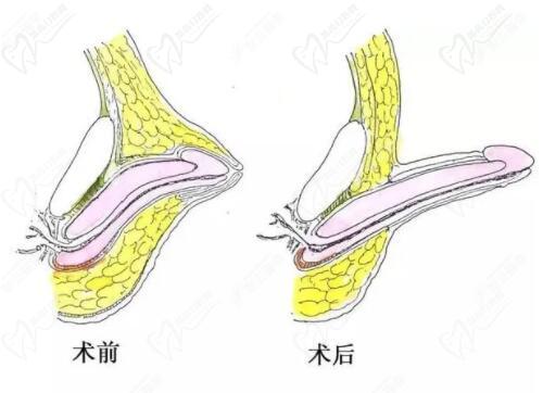 李世榮的延長術采用"三層遞進減張縫合"技術
