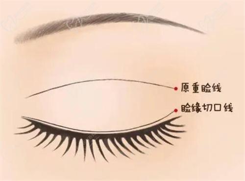 三、影響北京豐聯麗格整形醫(yī)院做雙眼皮價格的因素