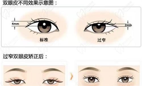 六、北京豐聯麗格整形醫(yī)院師麗麗醫(yī)生雙眼皮手術預約掛號方式