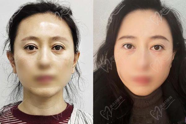上海張詩若修復雙眼皮內眼角怎么樣
