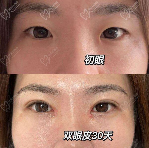 上海張詩若做眼睛怎么樣