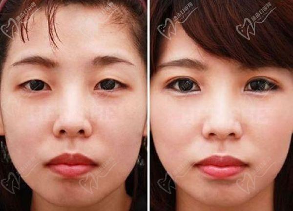 上海張詩若修復雙眼皮內眼角價格多少錢
