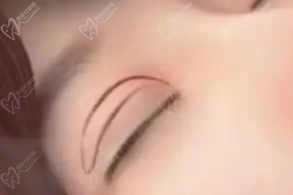 師麗麗雙眼皮修復(fù)手術(shù)項(xiàng)目優(yōu)勢分析