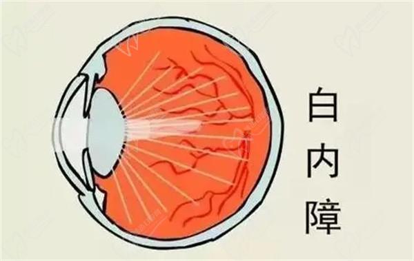 上海醫(yī)大眼科白內(nèi)障手術(shù)8千-3萬(wàn)起，不同品牌晶體價(jià)格有些許差異